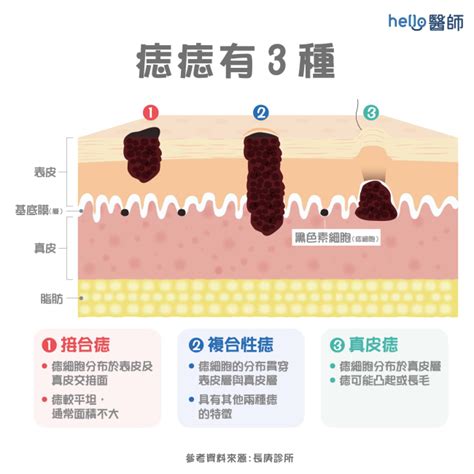 左眼下突然長痣|痣形成的原因？痣長毛、痣變多變大是痣病變？5招判別